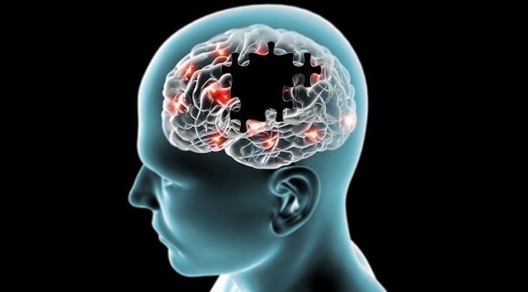Alzheimer Nedir? Belirtileri, Nedenleri ve Tedavi Yöntemleri